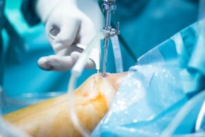 Read more about the article Arthroscopic Surgery or Physiotherapy: How Do You Know Which You Need?
